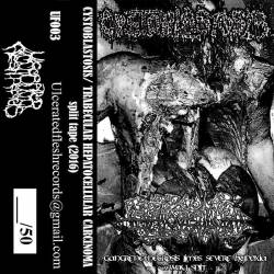 Trabecular Hepatocellular Carcinoma : Gangrene Necrosis Limbs Severe Hypoxia